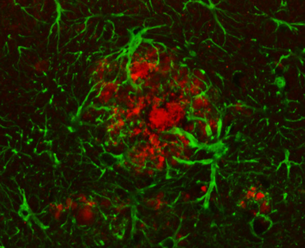 “Nos interesa el rol de la neuroinflamación en el proceso neurodegenerativo del cerebro. Tenemos indicios claros de que, en este proceso, los astrocitos (imagen) y las células de la microglía son afectados en forma temprana", explican los investigadores.